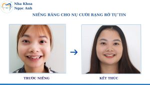 Sự thay đổi sau khi niềng răng tại Nha Khoa Ngọc Anh